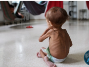 Desnutrición infantil https://editorials.voa.gov/a/7160468.html