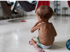 Desnutrición infantil https://editorials.voa.gov/a/7160468.html